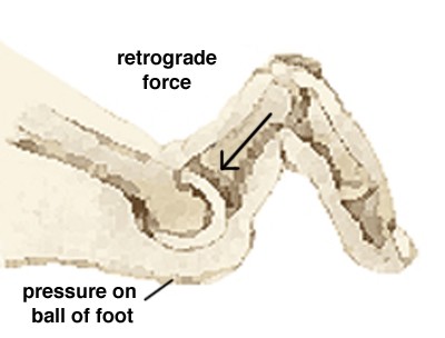 Hammertoe